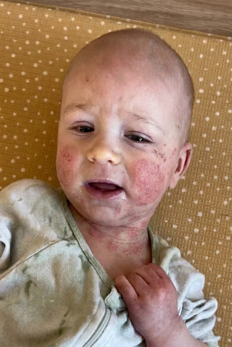Leonardo, bebê de 8 meses, com lesões de dermatite atópica no rosto e no pescoço, olhando para a câmera