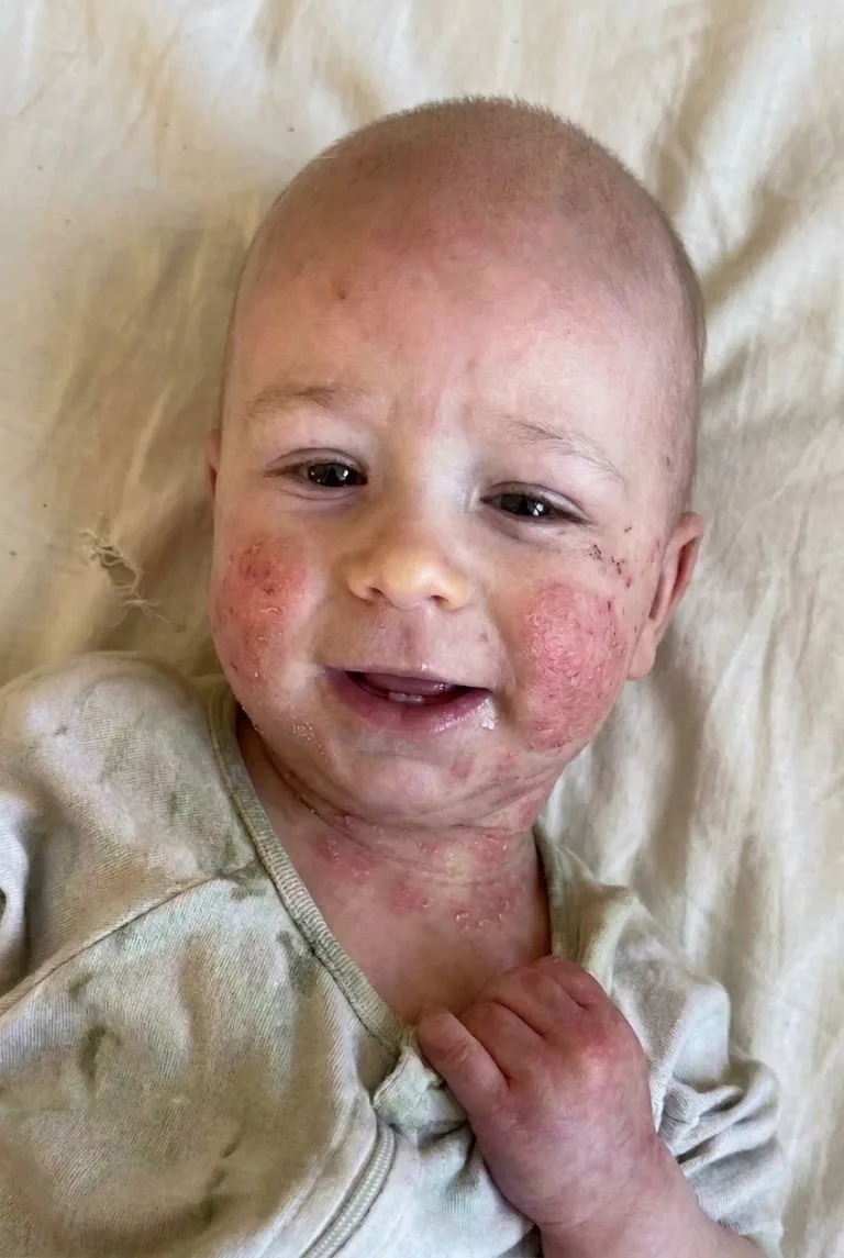 Leonardo sorrindo, deitado no lençol, mesmo com as feridas no rosto